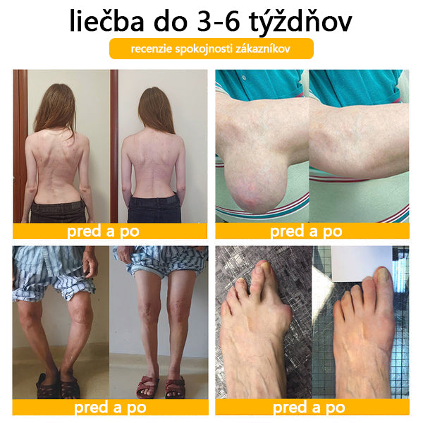 ADNOON® Krém na hojenie kostí s botulotoxínom a včelím jedom ⭐👨⚕️Schválené Slovenskou spoločnosťou ortopedie a traumatológie (SOTS)