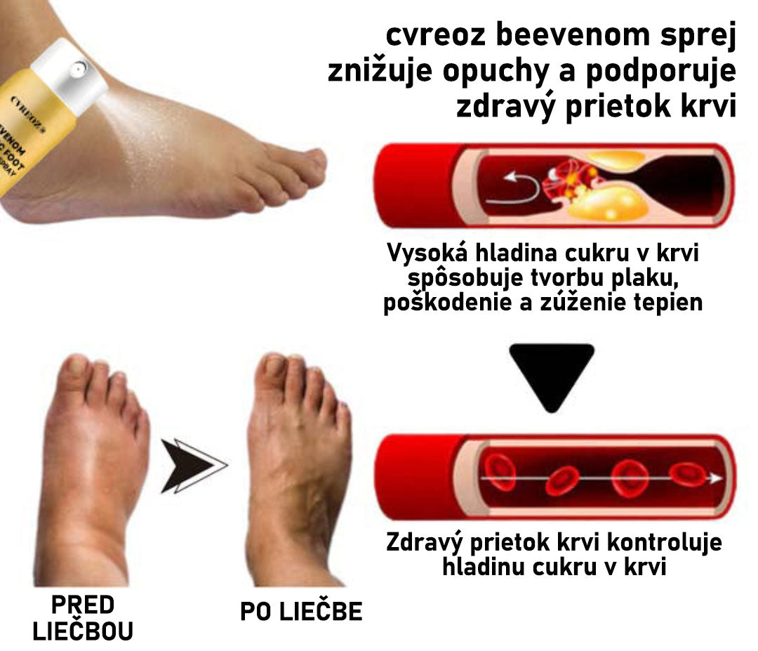 CVREOZ® Bee Venom Sprej na liečbu diabetickej nohy 🔥 Akcia na obmedzený čas – 60 % zľava 🔥