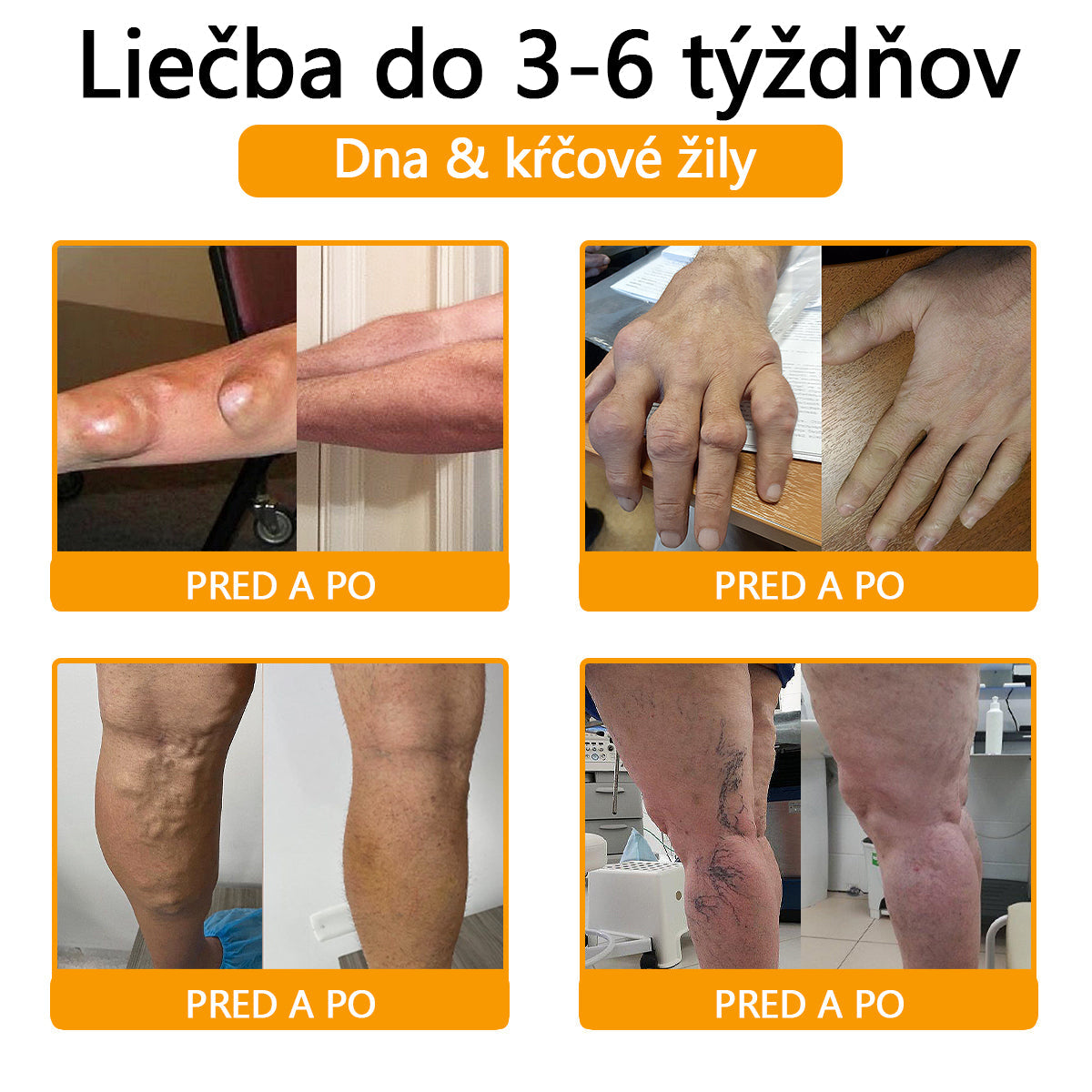 ADNOON® Krém na hojenie kostí s botulotoxínom a včelím jedom ⭐👨⚕️Schválené Slovenskou spoločnosťou ortopedie a traumatológie (SOTS)