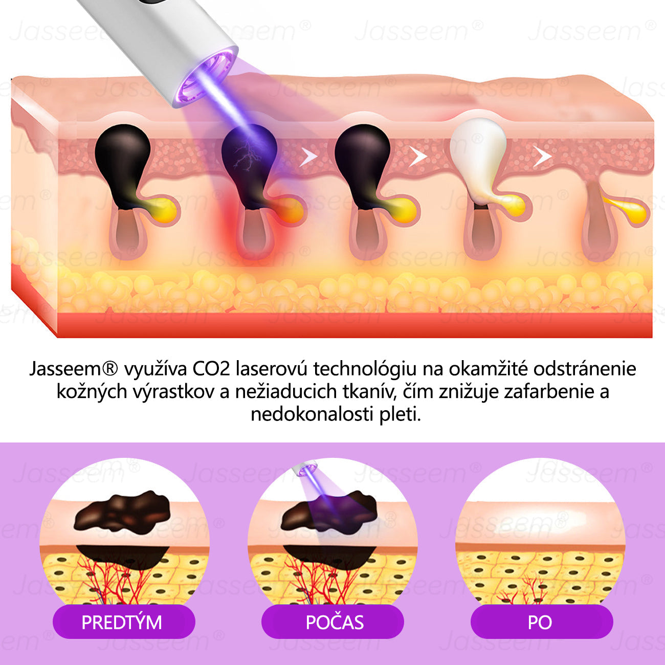 𝐉𝐚𝐬𝐬𝐞𝐞𝐦® Pokročilé neinvazívne CO₂ laserové pero na opravu pokožky 💕 (Jemne odstraňuje bradavice, materské znamienka, starecké škvrny a kožné výrastky – bez bolesti, bez starostí!)