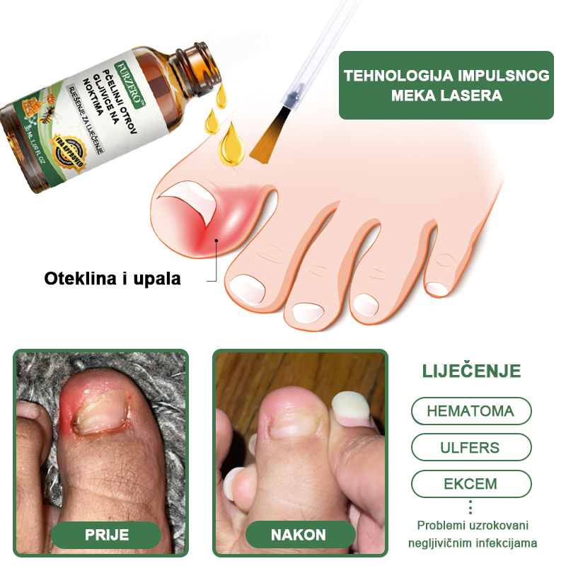 👩⚕️Furzero™ Ošetrujúce sérum proti včelímu jedu na nechty