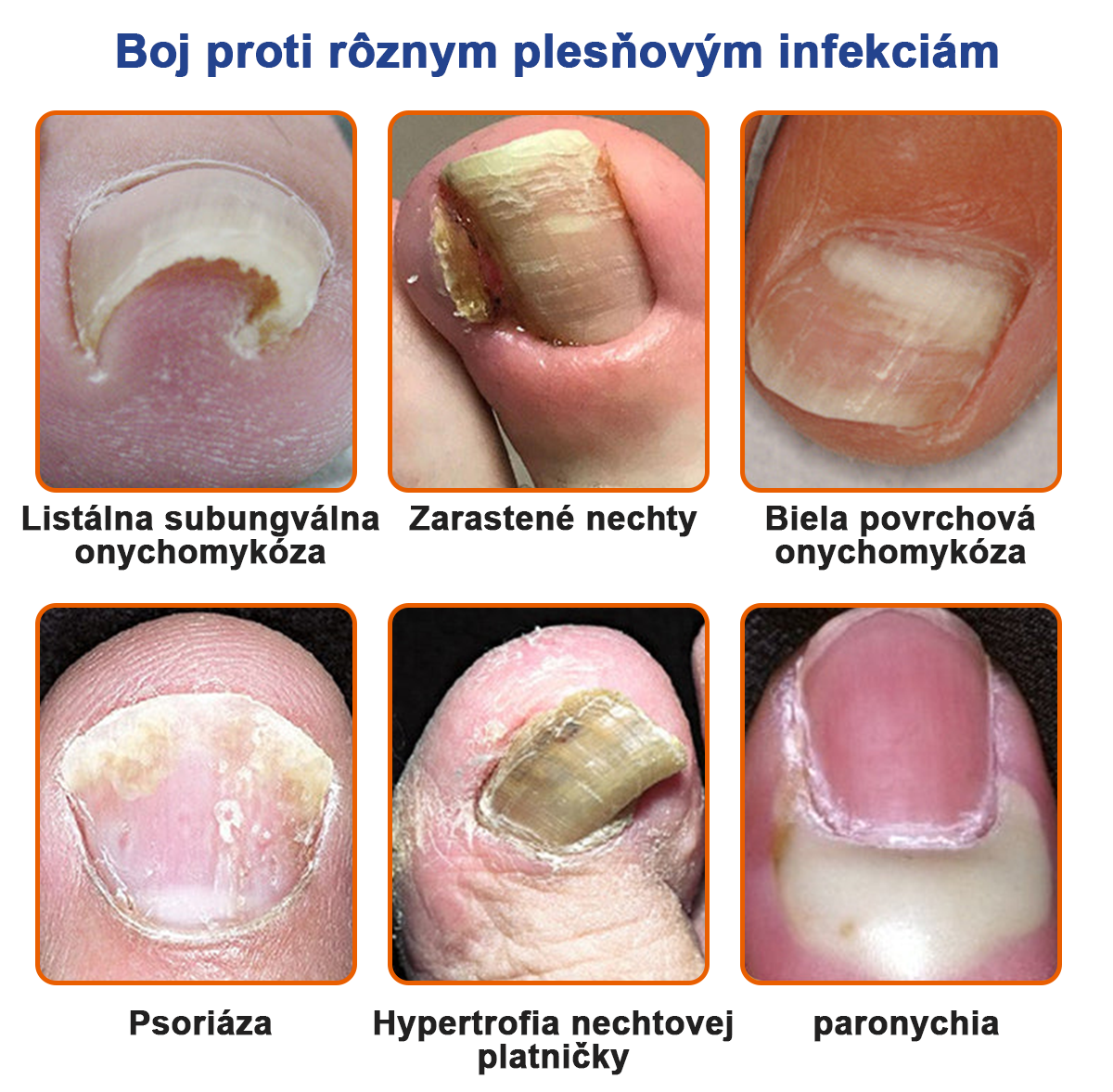 🐝Furzero™ Včelí jed na plesne na nechtoch: kompletné riešenie plesní na nechtoch 🌟👣