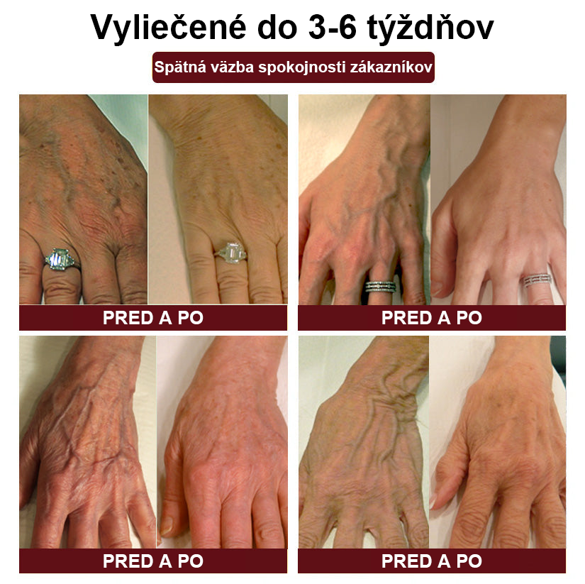 🦵🦵RAINDEW" Krém na kŕčové žily z pijaviek - PLUS (odporúča AVLS)