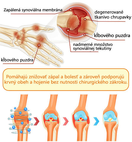 ADNOON® Krém na hojenie kostí s botulotoxínom a včelím jedom ⭐👨⚕️Schválené Slovenskou spoločnosťou ortopedie a traumatológie (SOTS)