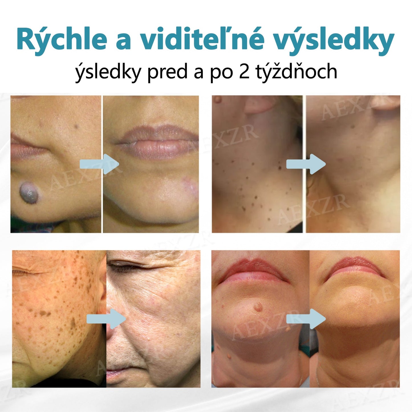 Bikenda® Neinvazívne laserové pero na odstránenie znamienok a bradavíc