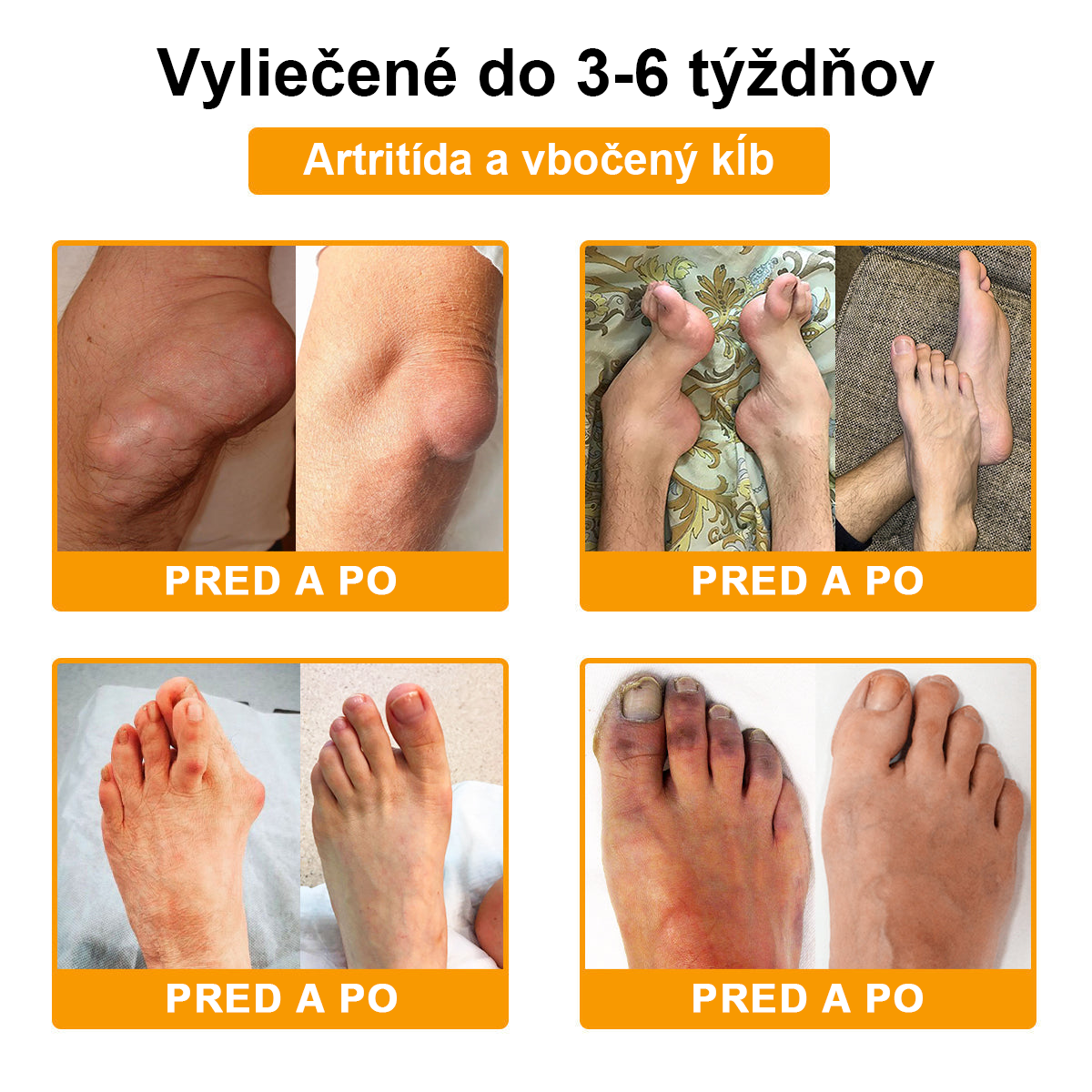ArthroFree™ Krém na bolesti kĺbov s včelím jedom na hojenie kostí(🐝odporúča AAOS)
