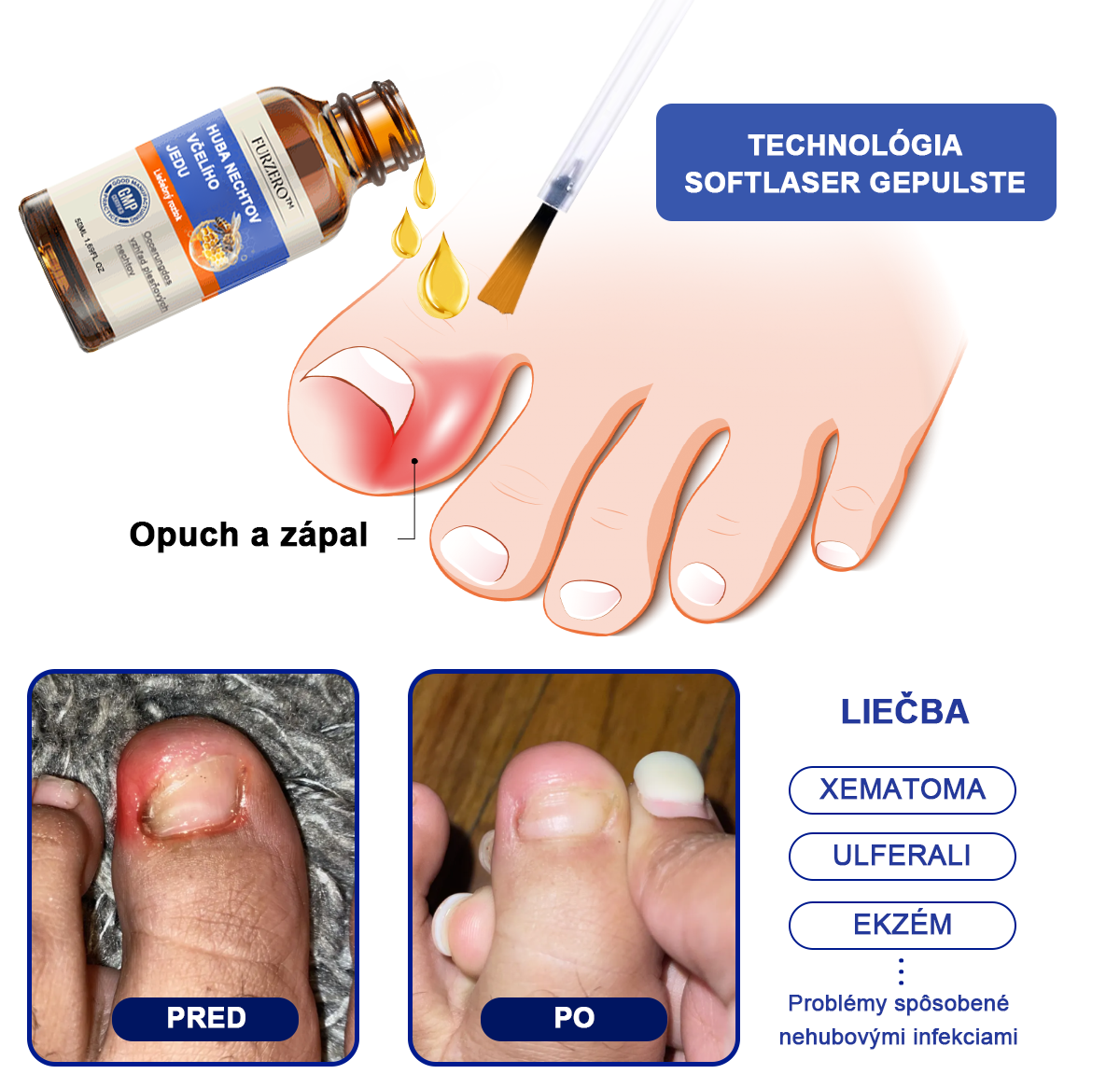 🐝Furzero™ Včelí jed na plesne na nechtoch: kompletné riešenie plesní na nechtoch 🌟👣