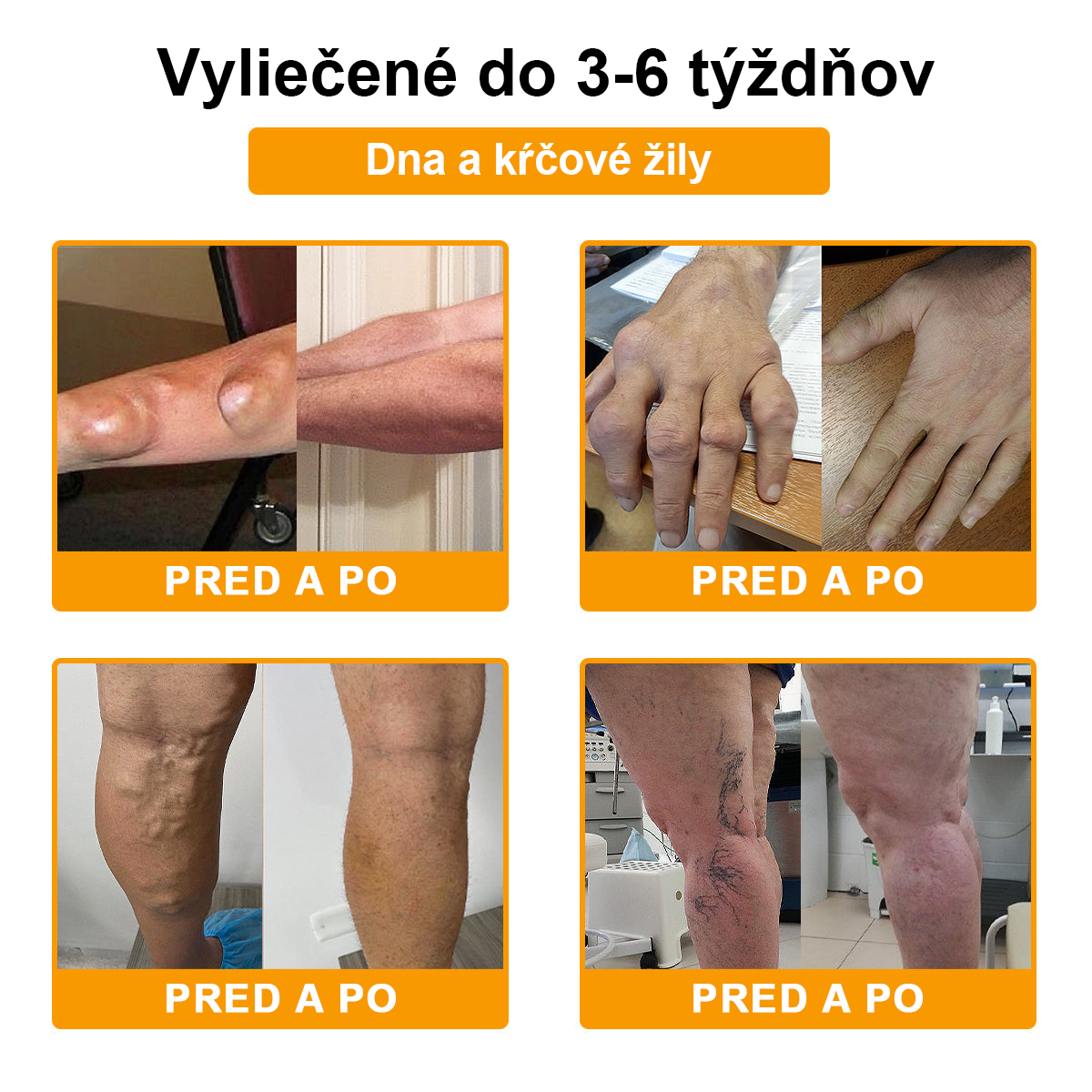 ArthroFree™ Krém na bolesti kĺbov s včelím jedom na hojenie kostí(🐝odporúča AAOS)