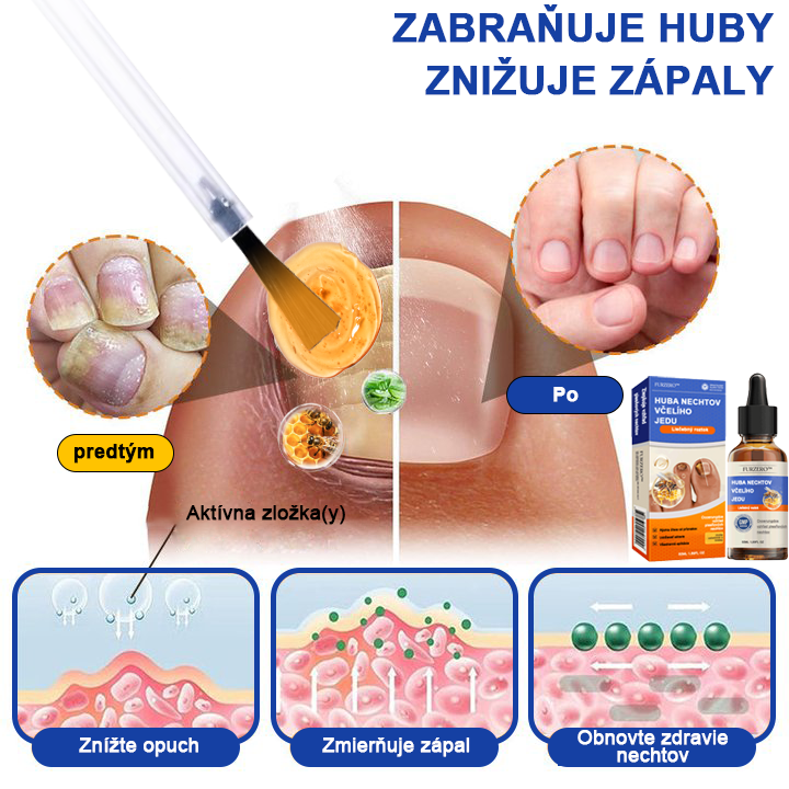🐝Furzero™ Včelí jed na plesne na nechtoch: kompletné riešenie plesní na nechtoch 🌟👣