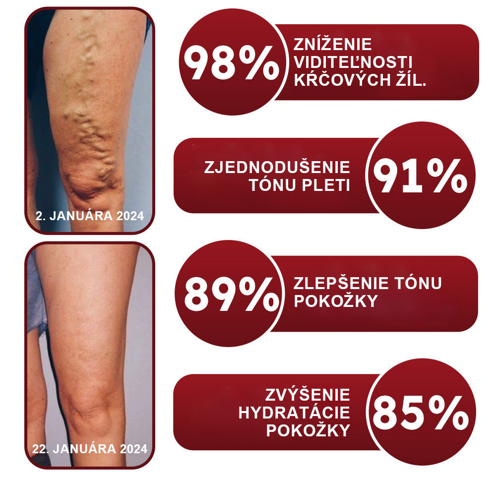 🦵🦵RAINDEW" Krém na kŕčové žily z pijaviek - PLUS (odporúča AVLS)