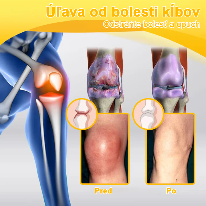 ArthroFree™ Krém na bolesti kĺbov s včelím jedom na hojenie kostí(🐝odporúča AAOS)