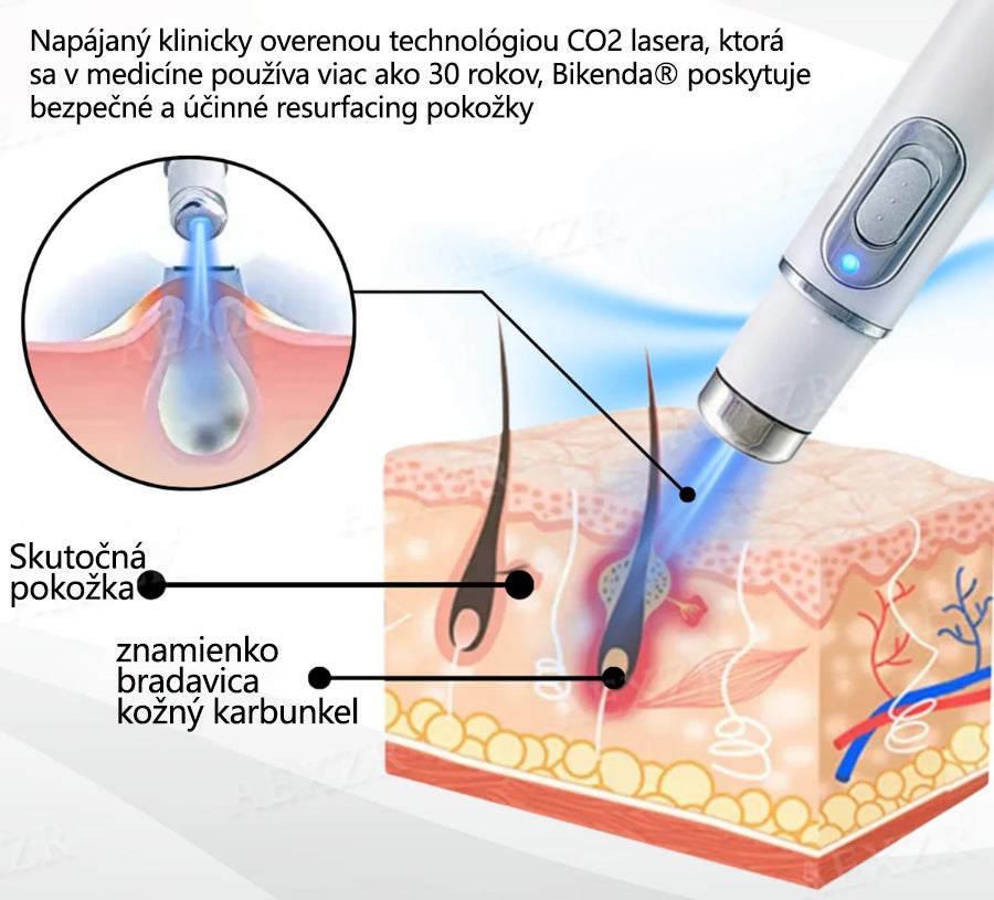 Bikenda® Neinvazívne laserové pero na odstránenie znamienok a bradavíc