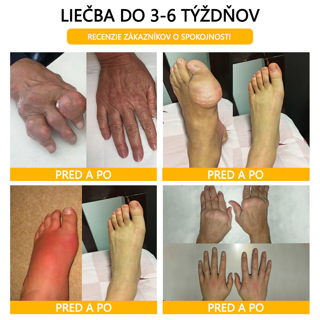 ADNOON® Krém na hojenie kostí s botulotoxínom a včelím jedom ⭐👨⚕️Schválené Slovenskou spoločnosťou ortopedie a traumatológie (SOTS)