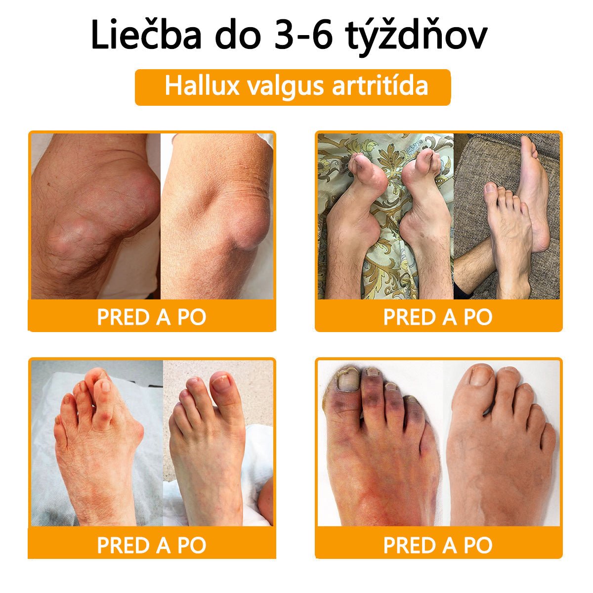 ADNOON® Krém na hojenie kostí s botulotoxínom a včelím jedom ⭐👨⚕️Schválené Slovenskou spoločnosťou ortopedie a traumatológie (SOTS)