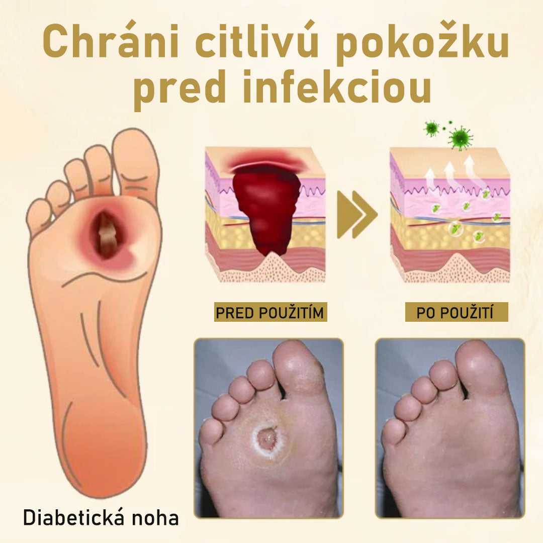 CVREOZ® Bee Venom Sprej na liečbu diabetickej nohy 🔥 Akcia na obmedzený čas – 60 % zľava 🔥