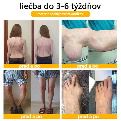 ADNOON® Krém na hojenie kostí s botulotoxínom a včelím jedom ⭐👨‍⚕️Schválené Slovenskou spoločnosťou ortopedie a traumatológie (SOTS)