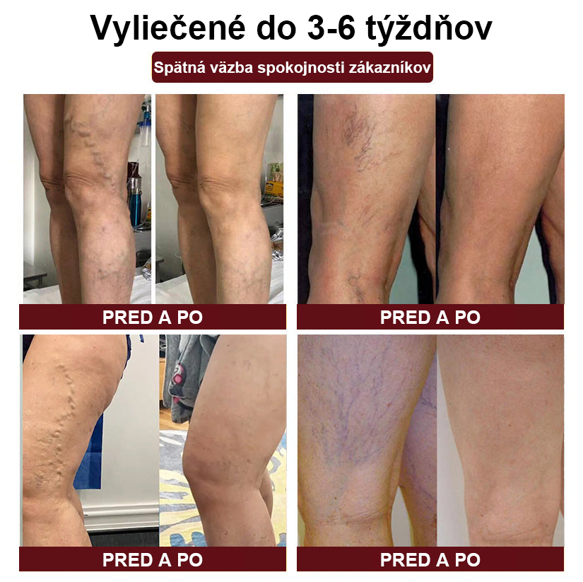 🦵🦵RAINDEW" Krém na kŕčové žily z pijaviek - PLUS (odporúča AVLS)