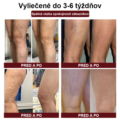🦵🦵RAINDEW" Krém na kŕčové žily z pijaviek - PLUS (odporúča AVLS)