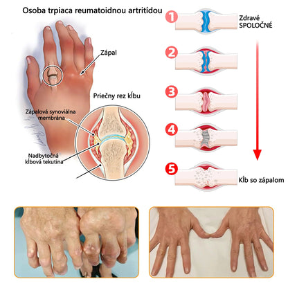 ADNOON® Krém na hojenie kostí s botulotoxínom a včelím jedom ⭐👨‍⚕️Schválené Slovenskou spoločnosťou ortopedie a traumatológie (SOTS)
