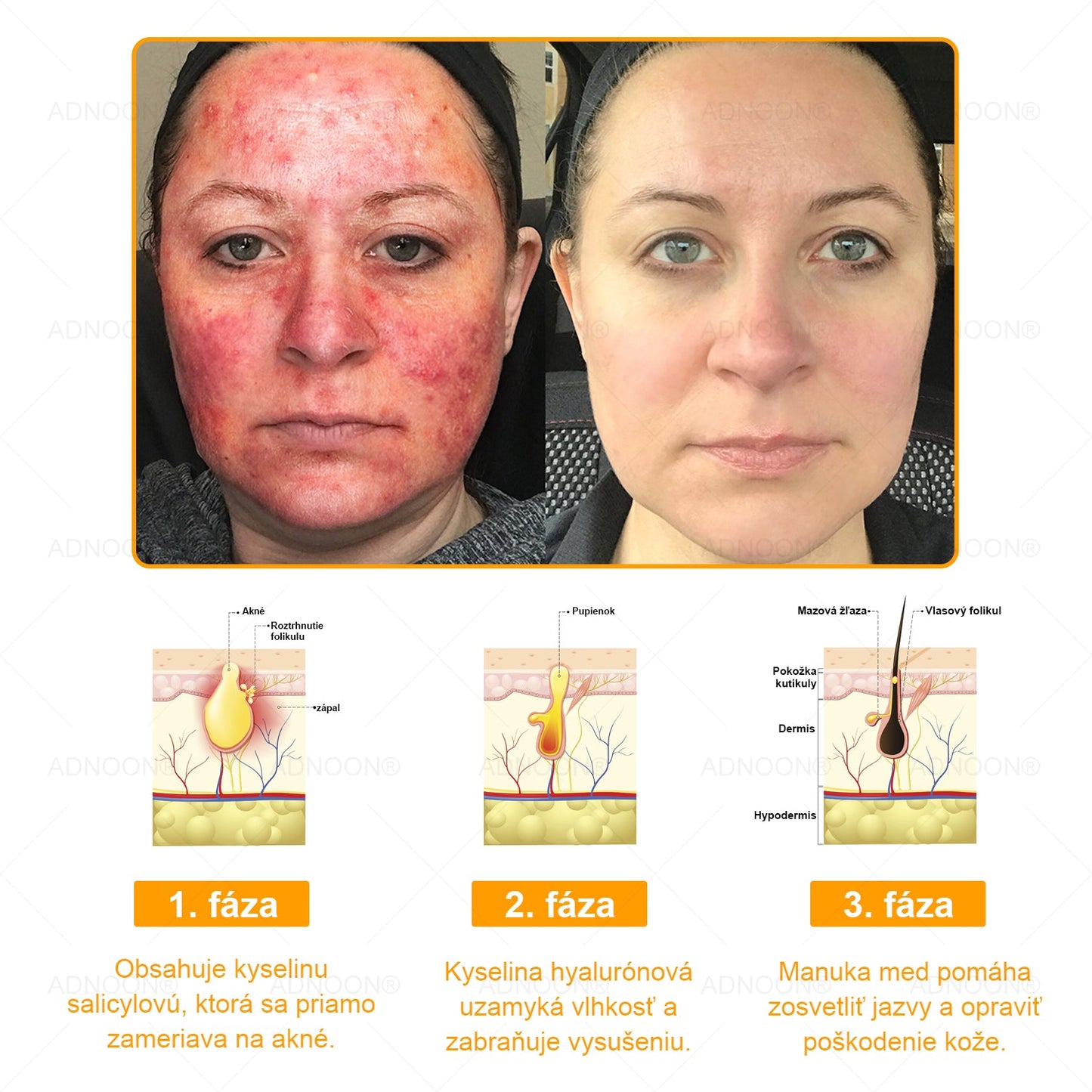 ADNOON® 🌼 Denný krém na rýchlu regeneráciu pokožky – odporúčaný Slovenskou dermatologickou spoločnosťou (SDS)👨‍⚕️.